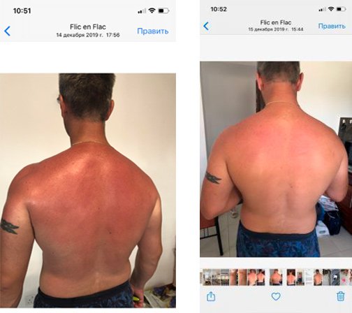 Картинки когда обгорел на солнце (63 фото)