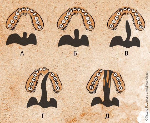 Расщепление твердого неба