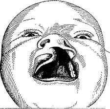 Волчья пасть расщепление неба