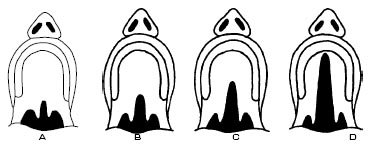 Волчья пасть расщепление неба