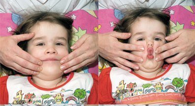 Ринолалия расщелина мягкого неба