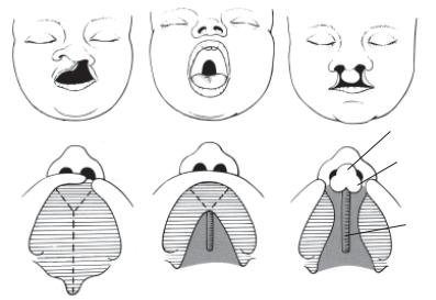 Врожденные расщелины неба мягкого неба