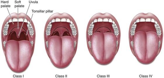 Односторонняя расщелина верхней губы и твердого неба