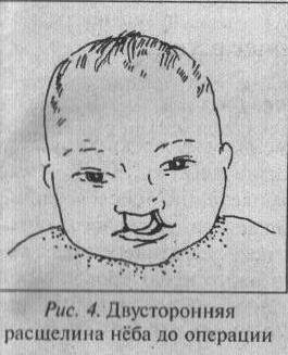 Картинки врожденные расщелины неба (69 фото)