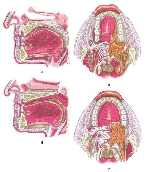 Невидимые (лингвальные) брекеты