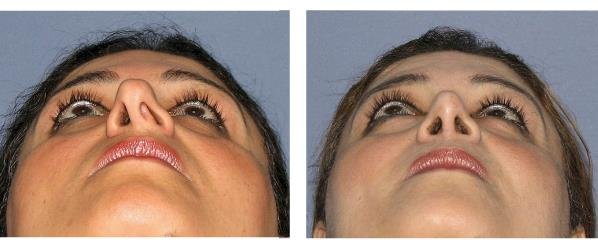 Зонд для постановки звука с