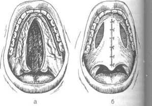 Синдром Аарского Скотта