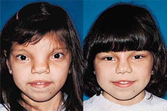 Субмукозная щель мягкое небо