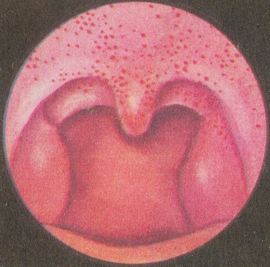 Язвенно некротическая ангина