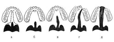Мягкое небо ротовой полости