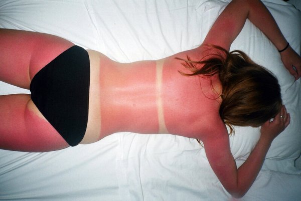 Сильно сгорел на солнце