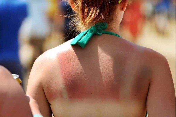 Обгоревшая на солнце кожа