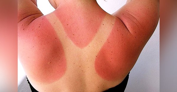 Фотодерматоз крапивница