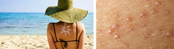 Волдыри на коже от солнца