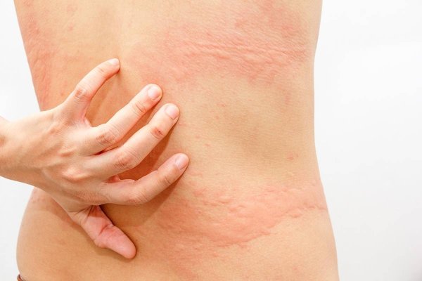 Аллергия на солнце: пятна на коже и причины фотодерматоза | Статьи med