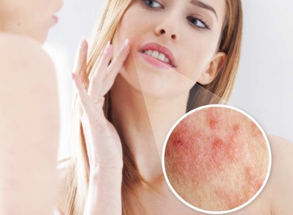 Околоротовой дерматит