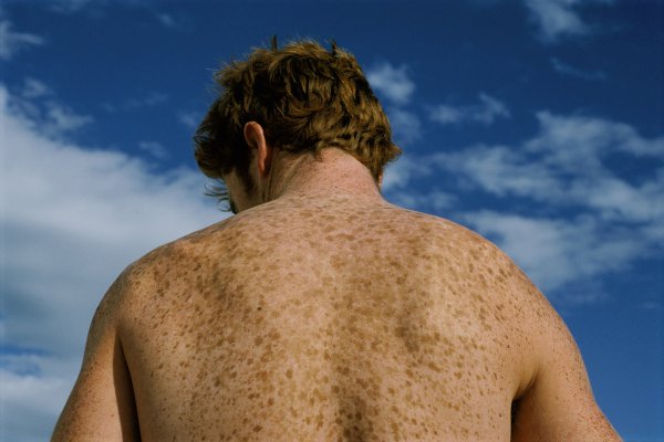 Конглобатные угри на спине