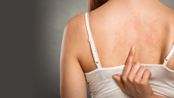 Холинергическая крапивница