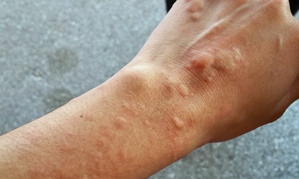 Крапивница фотодерматит