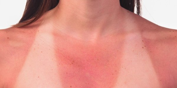 Кожные аллергические реакции