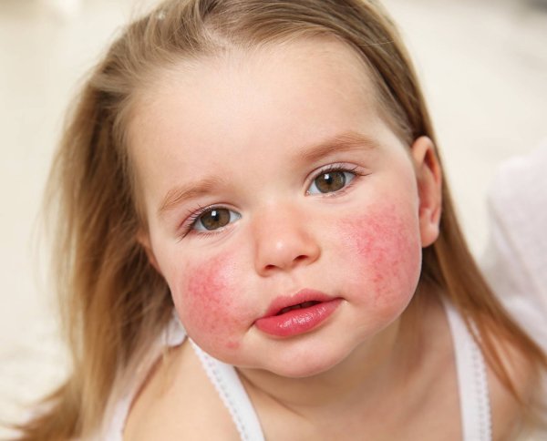 Аллергическая реакция у детей