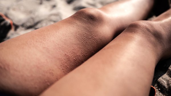 Волнообразная аллергия