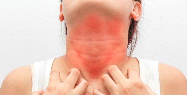 Холинергическая крапивница