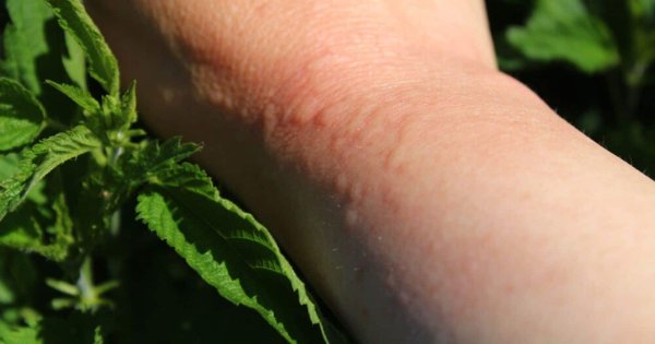 Колинэргическая крапивниц