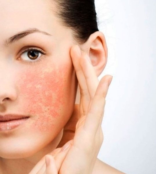 Сильнейший Солнечный ожог