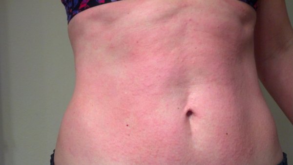 Аллергическая реакция на коже