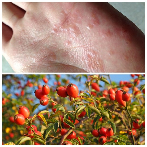 Аллергия на Солнечный загар