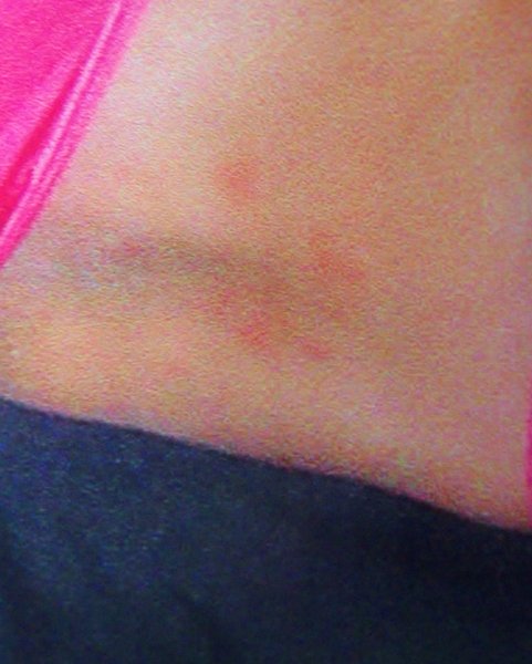 Аллергическая реакция на лекарства