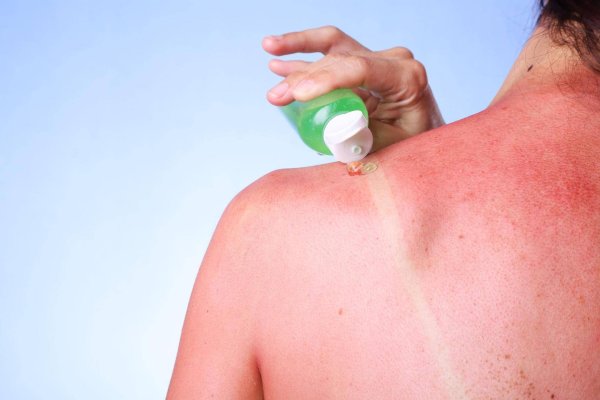 Ожог кожи 1 степени Солнечный