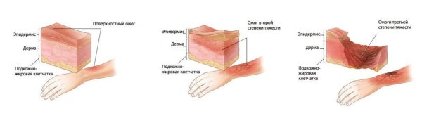 Солнечный ожог степени