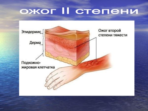 Солнечный ожог признаки