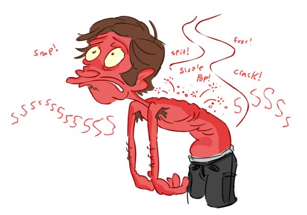 Обгорел на солнце картинка