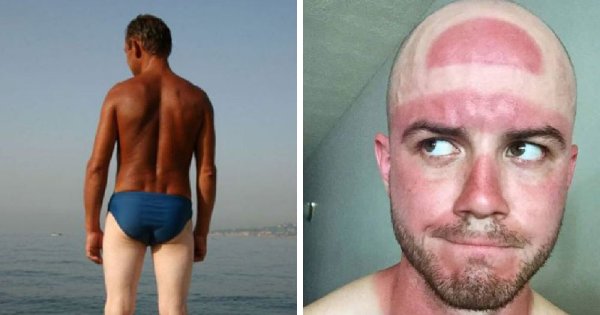 Обгорел на солнце прикол