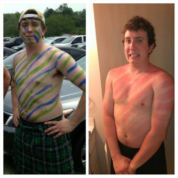 Парень обгорел на солнце