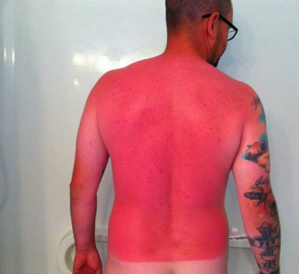 Человек обгорел на солнце