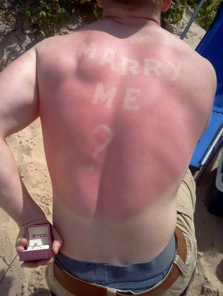 Человек обгорел на солнце