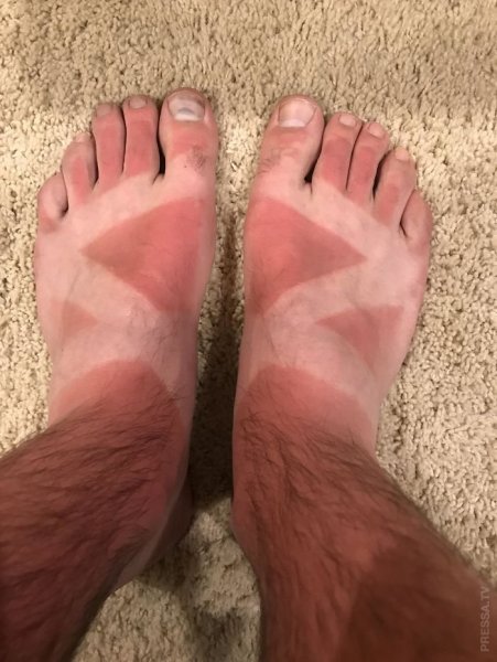 Мужчина обгорел на солнце