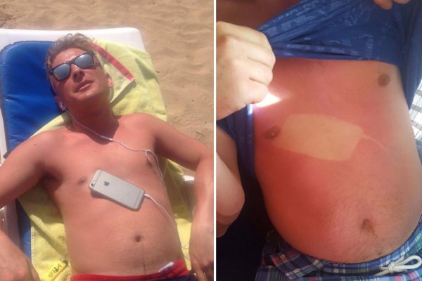 Сильно сгорел на солнце