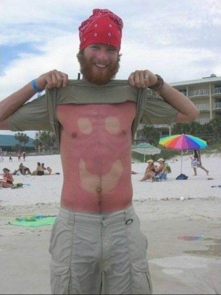 Мемы про сгоревшую кожу