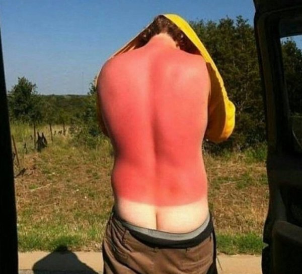 Сильно сгорел на солнце