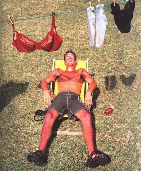 Обгоревший человек на солнце