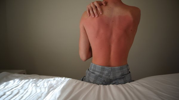 Сильнейший Солнечный ожог