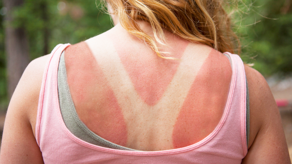 Сильнейший Солнечный ожог