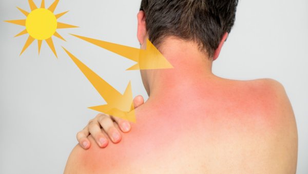 Сильно сгорел на солнце