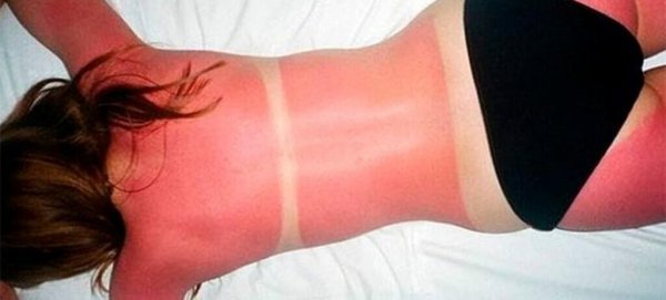 Загорание на солнце