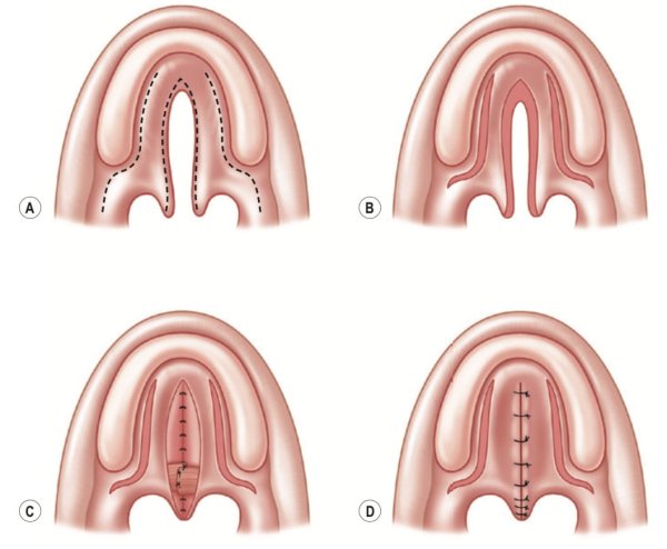 Расщелина твердого и мягкого неба